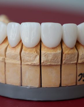 Dental Veneers In Bondi, Bondi Junction, Sydney At - Sydney Cosmetic Dentist