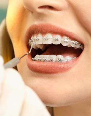 Orthodontics In Bondi, Bondi Junction, Sydney At Sydney Cosmetic Dentist