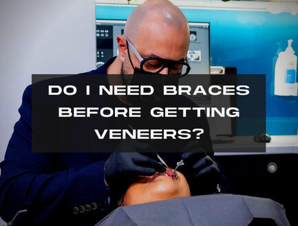 Do I Need Braces Before Getting Veneers?