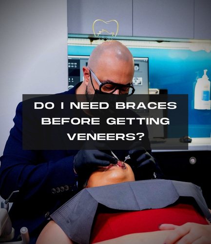Do I Need Braces Before Getting Veneers?