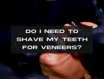 Do I Need to Shave My Teeth for Veneers?