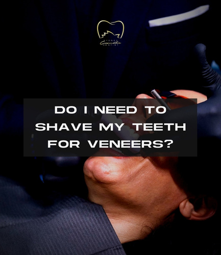 Do I Need to Shave My Teeth for Veneers?