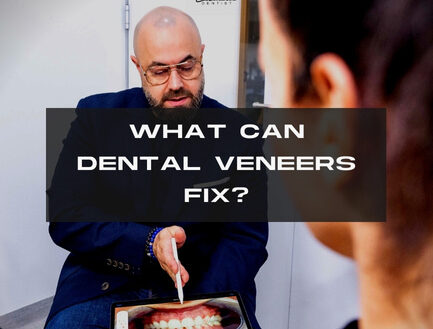 What Can Dental Veneers Fix?