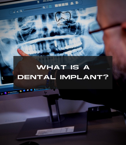 What Is a Dental Implant?