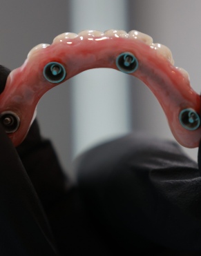 All Teeth On Four In Bondi, Bondi Junction, Sydney At Sydney Cosmetic Dentist