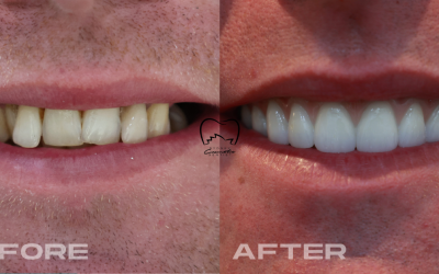 Full Arch Implants Clinical Case in Zetland