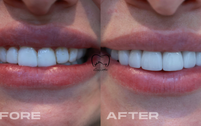 Smile Design Veneers Clinical Case in Dulwich Hill
